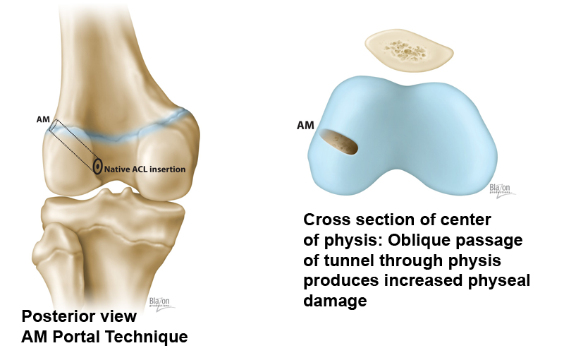 ACL Reconstruction Accelerated Rehabilitation - Northeast